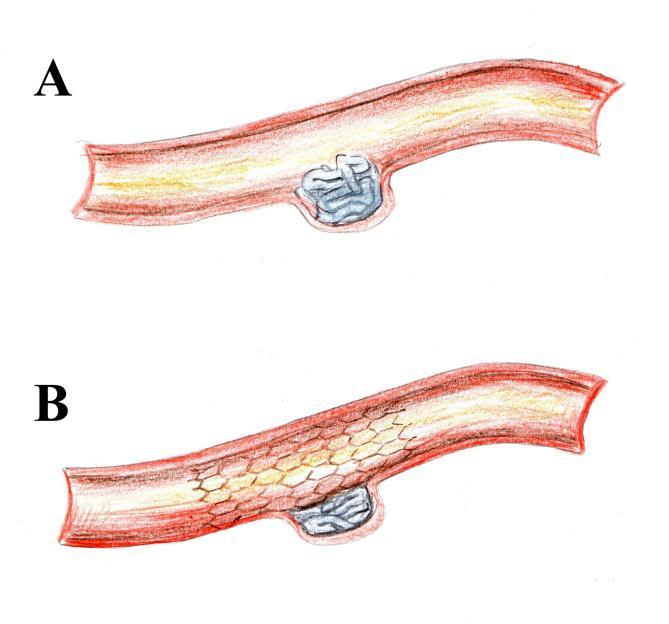 Slika 8. Finishing stent. A. Zavojnična masa blago protrudira u lumen matične arterije. B. Zavojnice su potisnute natrag u aneurizmu postavljanjem završavajuće potpornice.