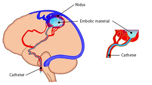 Slika 16. Shema primjene embolizacijskog agensa u nidus AVM-a. (http://neurosurgery.med.u-tokai.ac.jp/en/patients/avm/treatment.html) Slika 17. Angiografski prikaz faza liječenjea AVM-a.
