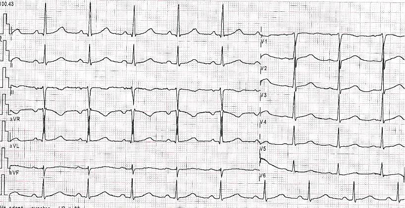 Oana Savu et al. Romanian Journal of Cardiology Figure 1. ECG: sinus rhythm, normal QRS complex and no ST-T abnormalities. tricular ejection fraction. Moderate pulmonary hypertension was noted.