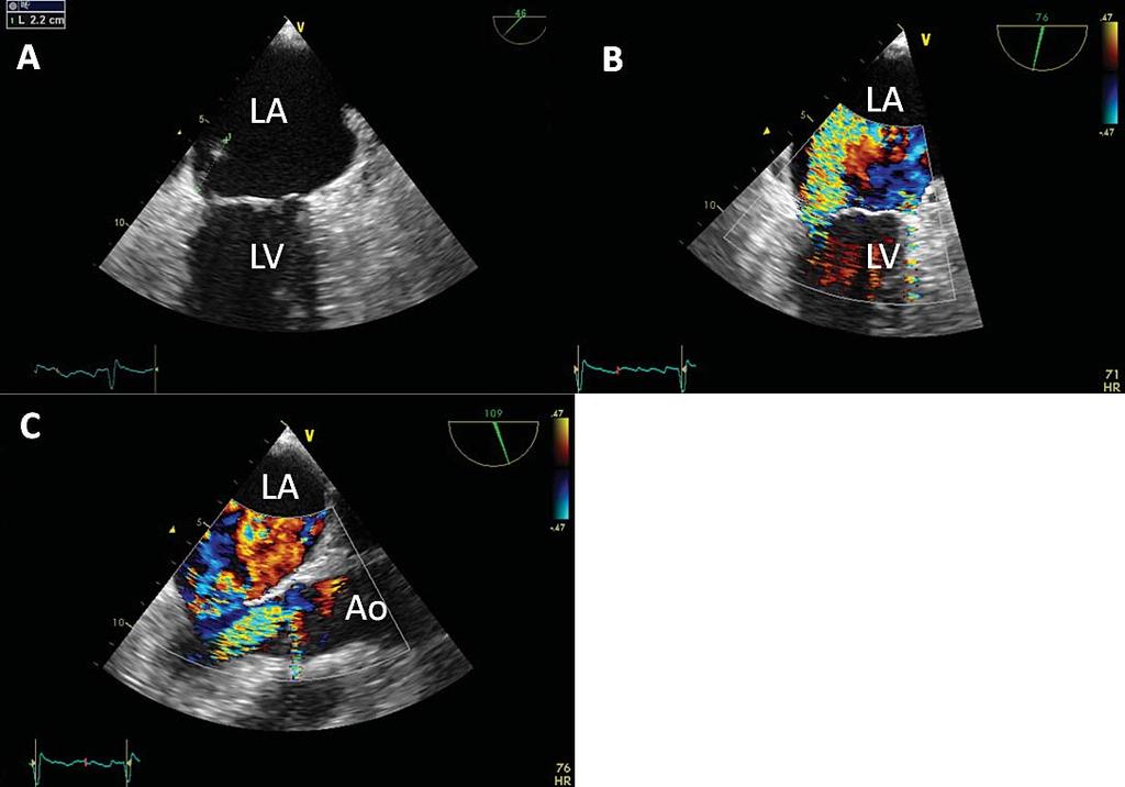 Color Doppler imaging shows moderate-severe aortic regurgitation. LA left atrium, LV left ventricle, Ao ascending aorta.
