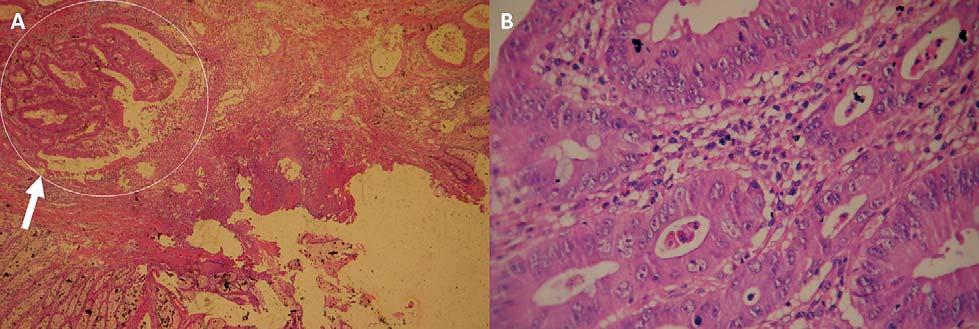 Oana Savu et al. Romanian Journal of Cardiology Figure 5. Histopathological examination of one of the resected pedunculated polyps optic microscopy, haematoxilin-eosin staining (HE). A.