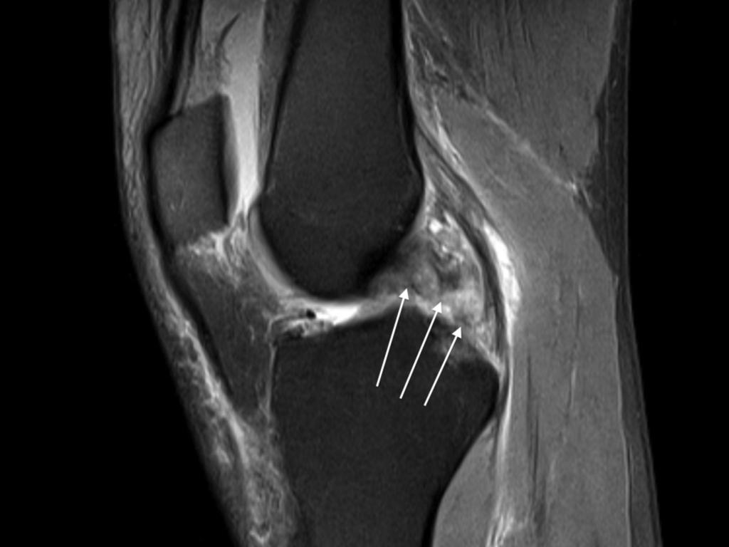 Learning objectives The combination of rupture of the PCL and medial stripping of periost from the femoral epicondyle (figure 1 and 2) presents a peculiar finding that may confuse the radiologist and