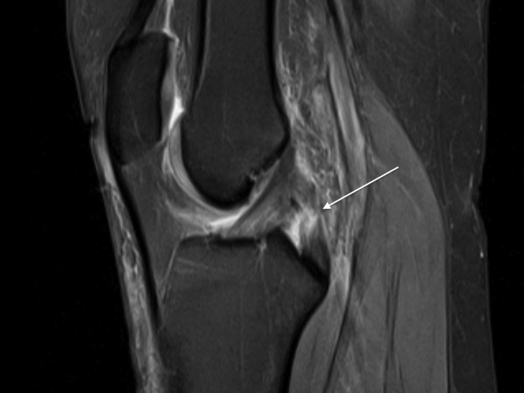 Background In an article from 2009 (reference 1), McAnally et al discussed the association of PCL injury and medial femoral epicondylar periosteal stripping.