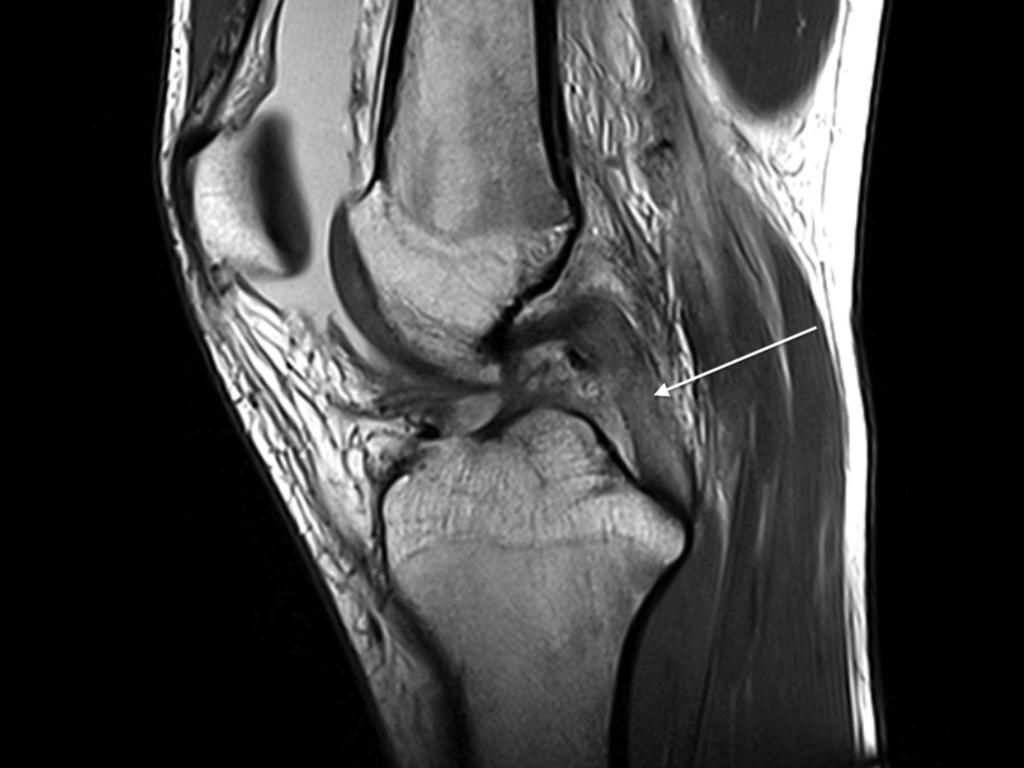 The follow up imaging of 4 patients revealed a normalization in three of the patients at the medial side of the knee, with resolution of the initial changes.