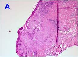 basal cell carcinoma.