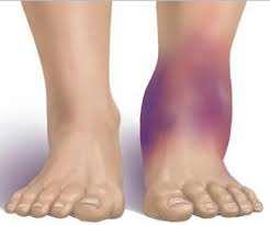 Epidemiology Syndesmotic Injuries: 1% to 18% of all ankle sprains 32% develop calcification and chronic pain