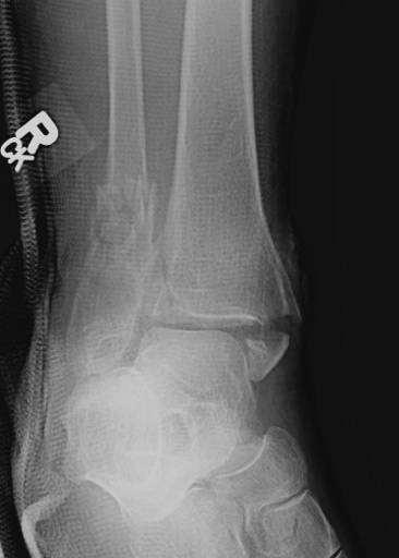 Osteoporotic Ankle Fractures Issues: Precarious Soft