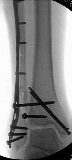 Technical Tips- Medial Malleolus Bicortical screws Caution