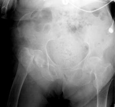 Hip Fractures Of all fall-related fractures, hip fractures lead to the greatest number of deaths, severe