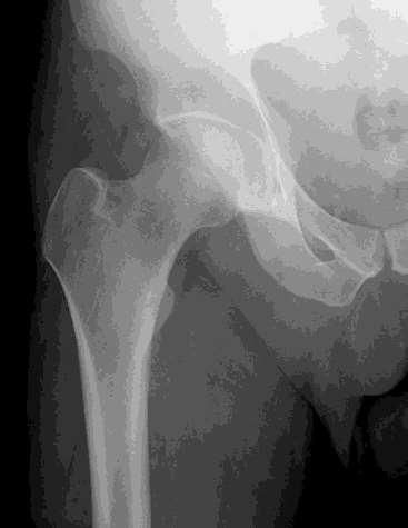 Femoral Neck Fractures Intracapsular hip