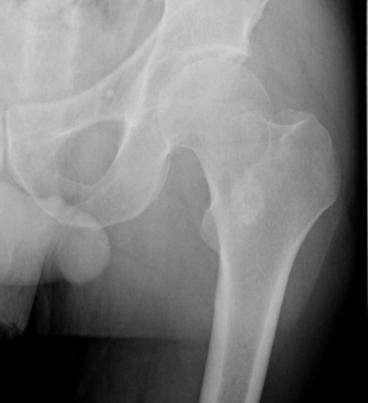 Femoral Neck Fractures Nondisplaced Fxs