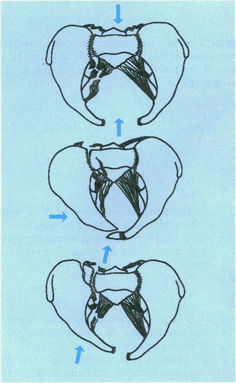 Mechanism of injury Patterns of force leading to pelvic There are four patterns of force leading to pelvic damage (fig 3).