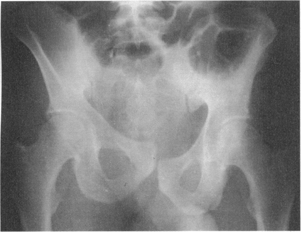As the pelvis is not completely rigid, this disruption may take the form of a minimal diastasis, which can be difficult to see. The pelvic brim cannot be disrupted in only one place.