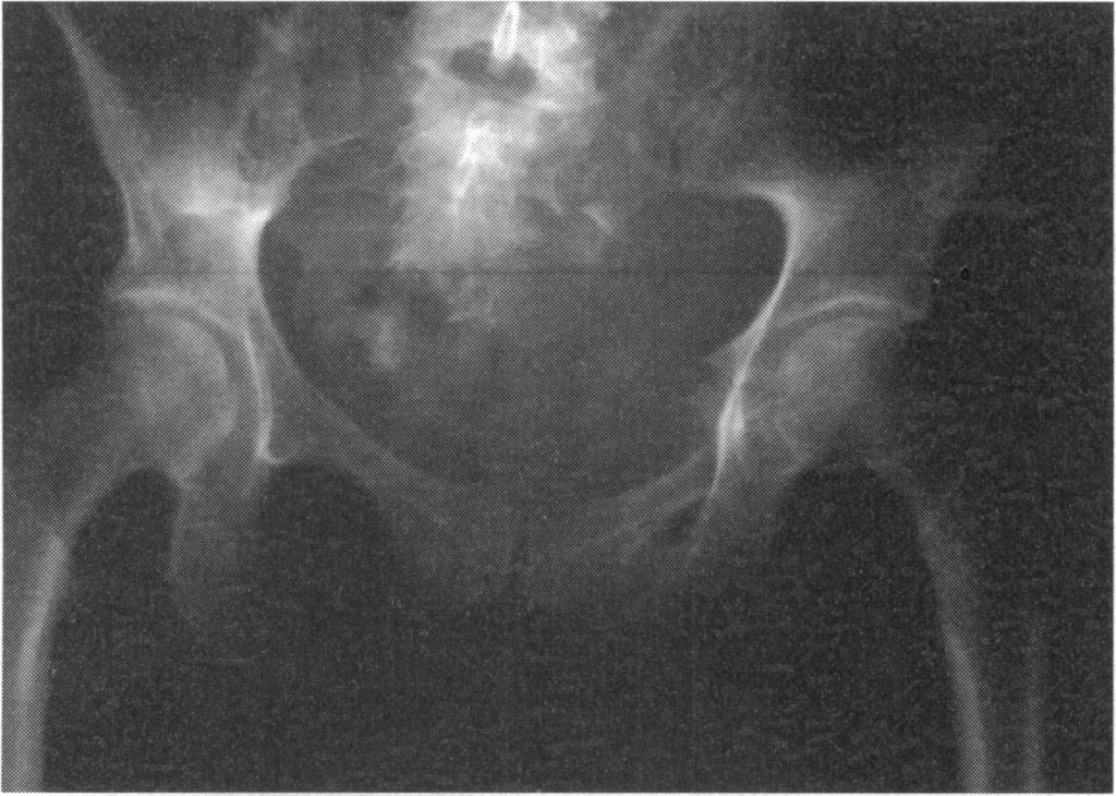 FIG 7-Anteroposterior radiograph showing disruption of lines around th ie acetabulum due.to a central dislocation of the left hip.