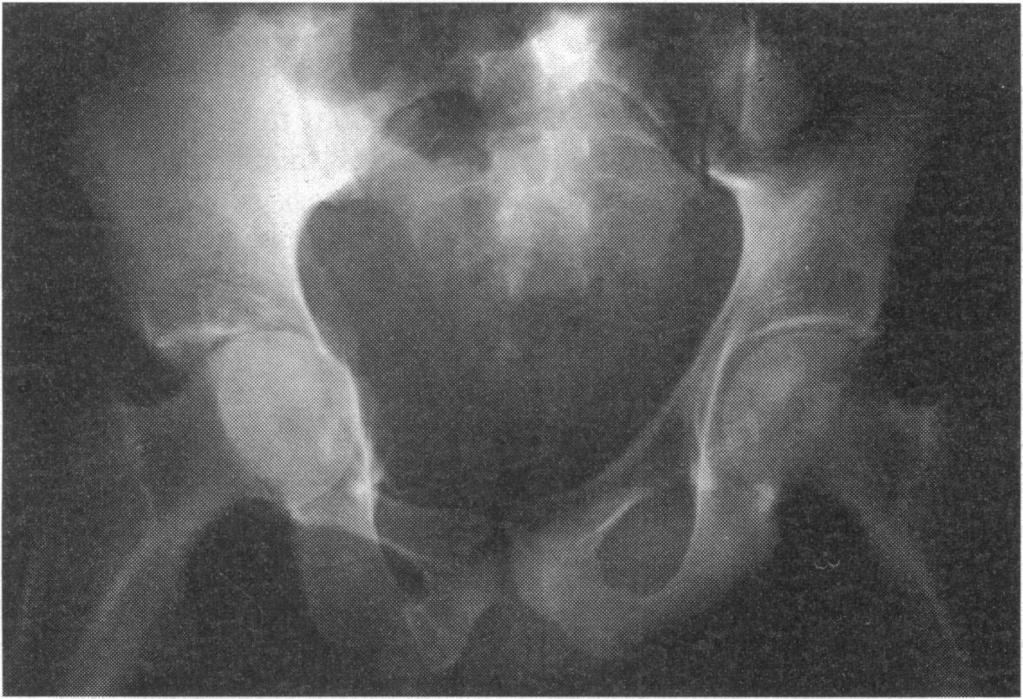 FIG 8-MAn[erUpos[eriur rauio[rapn snowing severai adnurmaiities aiter lateral compression injury. The pelvic brim on the right is disrupted because of fracture of the superior and inferior pubic rami.