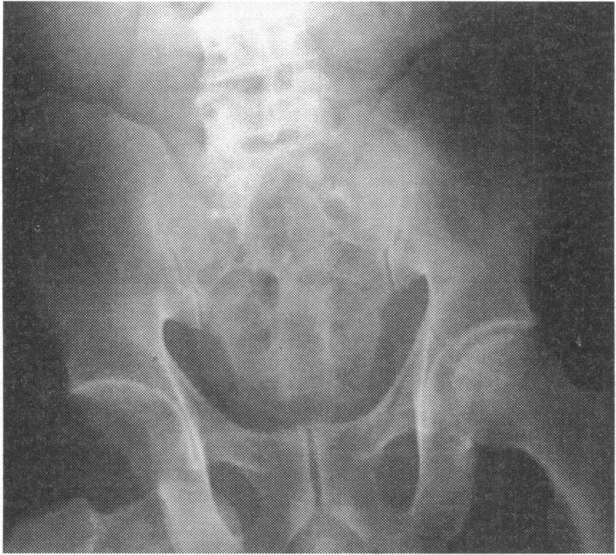FIG 9-Anteroposterior radiograph showing a fracture of the posterior aspect of the left acetabulum and dislocation of the right hip.