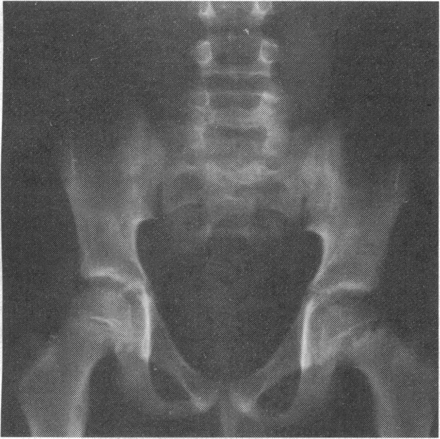 Radiological indicators of pelvic instability Pubic symphysis diastatis > 2.