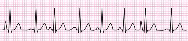 Rate P-P Regularity R-R Regularity P wave P:QRS Ratio PR Interval QRS Width Greater than 100bpm