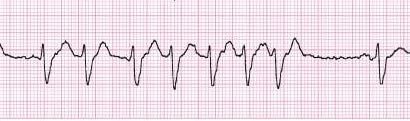 Rate P-P Regularity R-R Regularity P wave P:QRS Ratio PR Interval QRS Width Depends on the underlying Atrial Fibrillation,