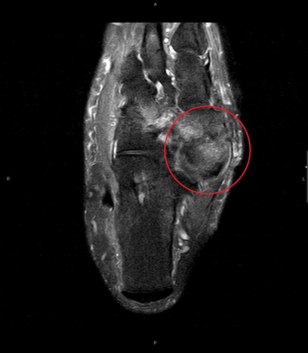 Fig. 7: Coronal T2 SPIR MRI image of tipe II accessory scaphoid (red circle).