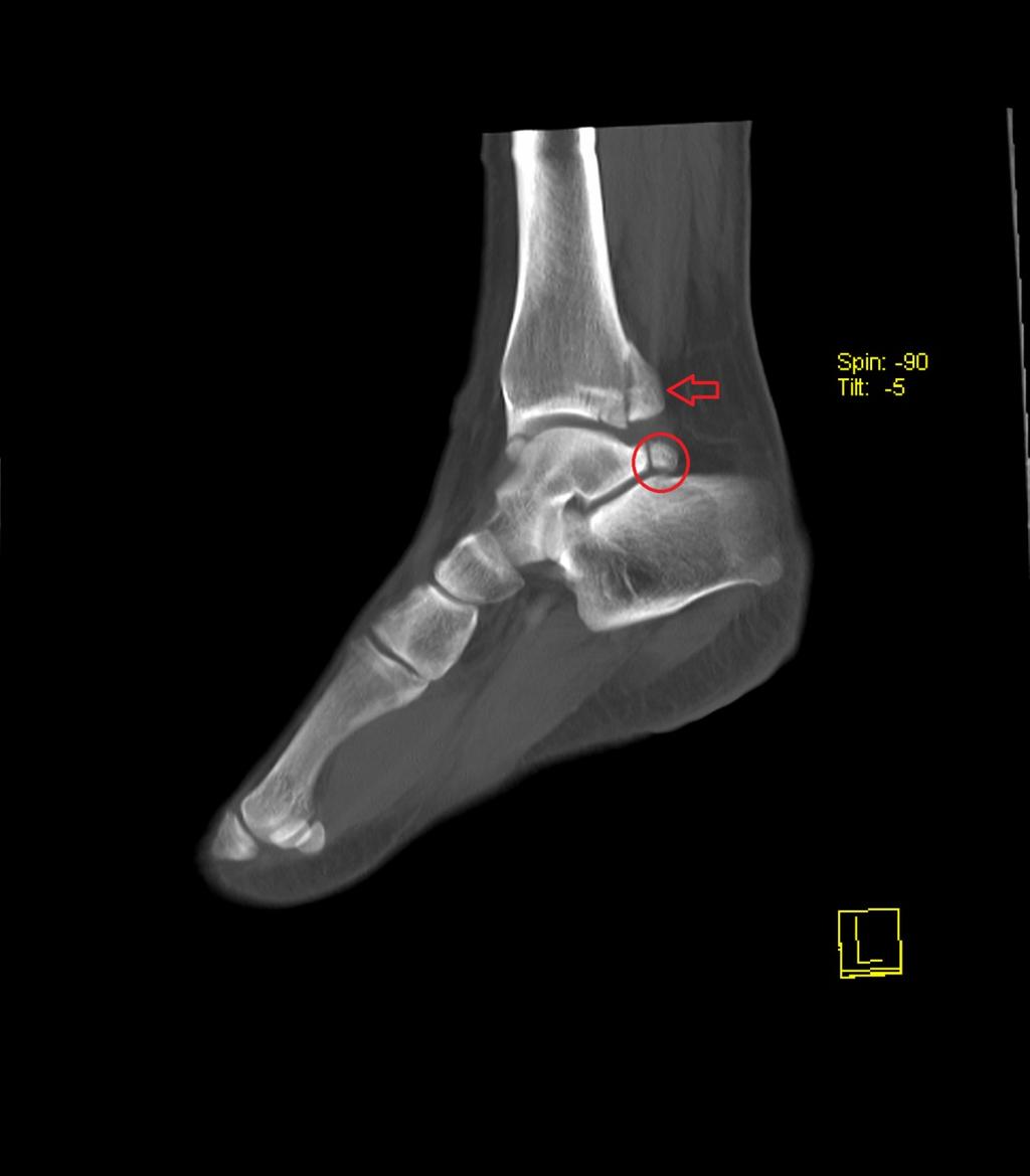 Fig. 8: Sagital thick slice MPR reconstruction of richt ankle showing os trigonum
