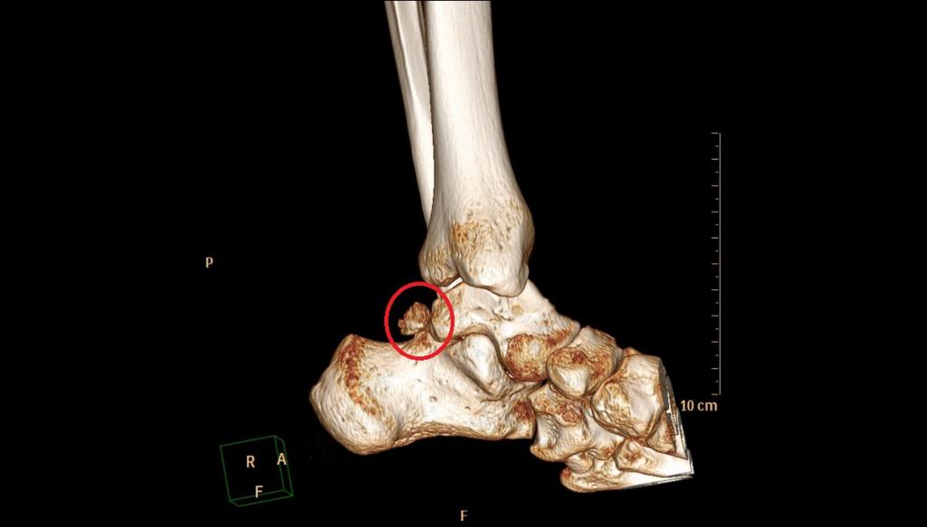 Fig. 9: Sagital 3D reconstruction of richt ankle showing os trigonum (red