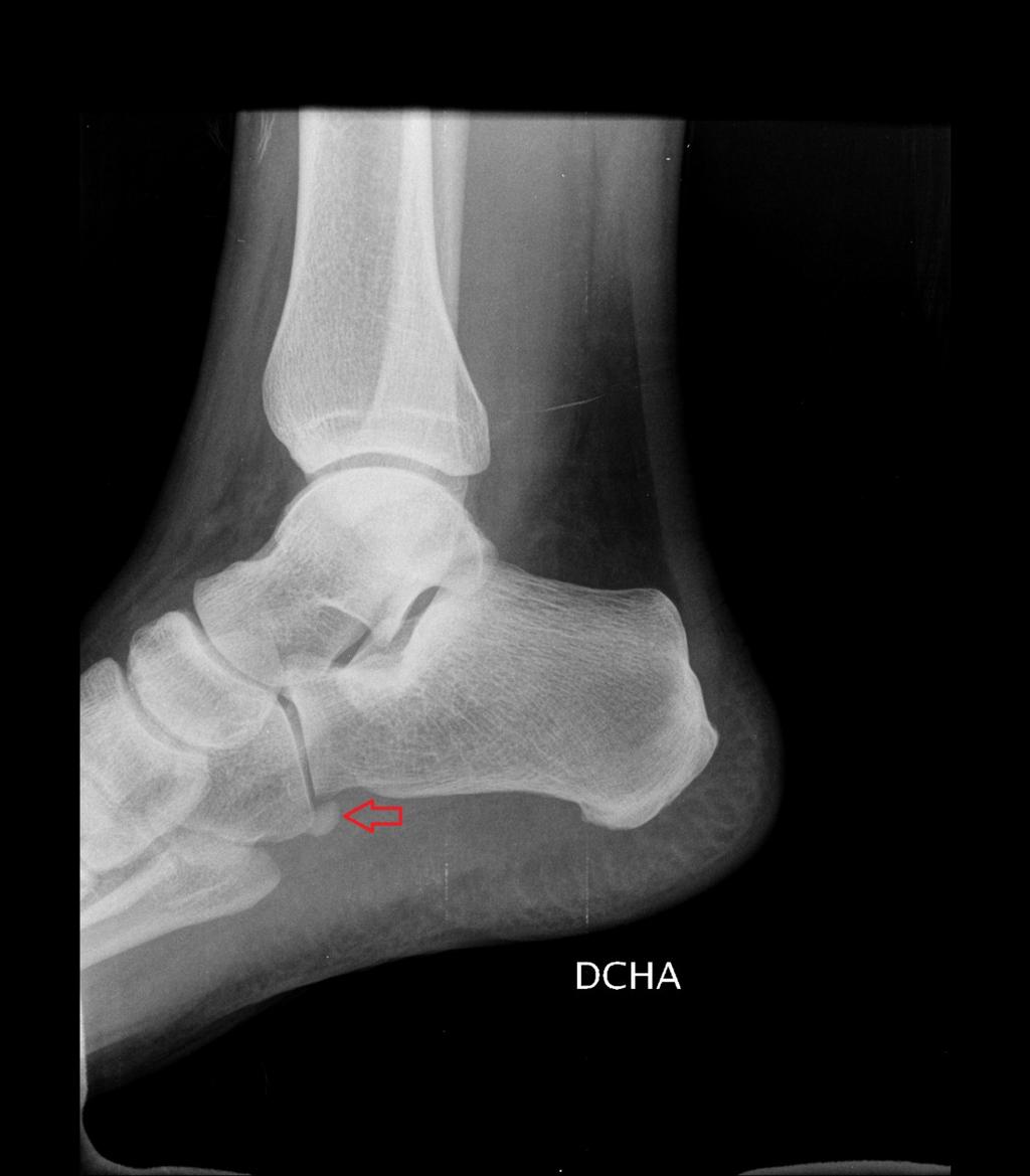 Fig. 1: Lateral radiography of the right