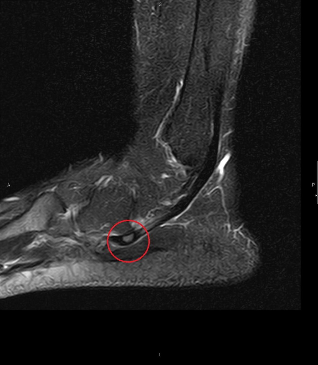 Fig. 3: Right ankle lateral radiography showing os peroneum (red arrow). Fig.