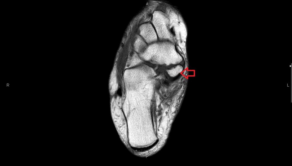 Fig. 5: Axial T1 MRI image of the ankle with