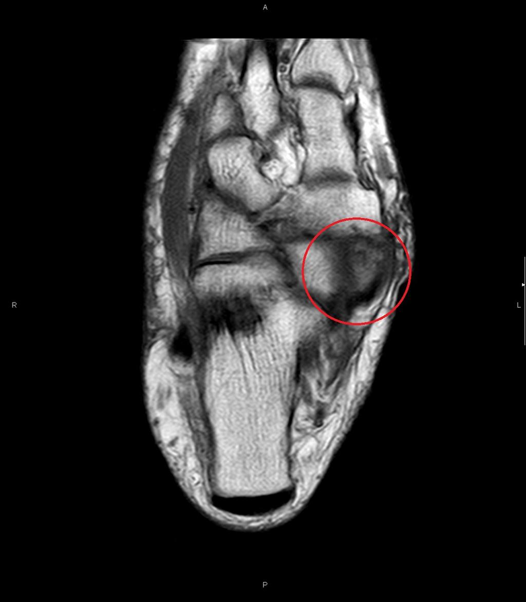 Fig. 6: Coronal T1 MRI image of he ankle withtipe II accessory scaphoid (red circle). There is loss of signal in the accessory scaphoid due to bone edema.