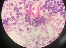 leukemia, MPO-Myeloperoxidase, NSE-Non-specific esterase, PAS-Periodic Acid Schiff, BM-bone marrow Introduction Leukemias are the neoplastic proliferations of hemopoietic cells [1].