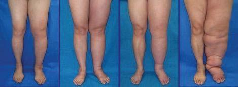 Secondary Lymphedema Stages of Lymphedema Damaged lymph vessel or node from surgery. Radiation can cause scarring and inflammation of LN or LV, restricts flow of fluid.