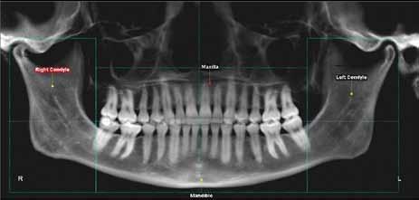 Proximal segments, maxilla and mandible Step 2: Crop