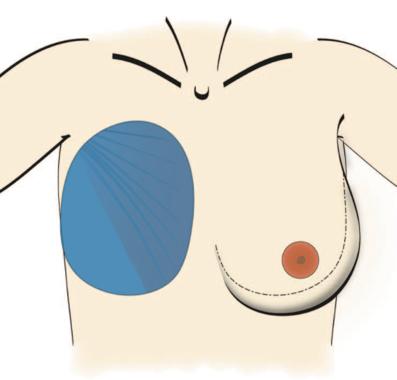 Starting from the pectoralis tendon 3 to 6 cm below the superior most point of the anterior axillary fold, extending down the lateral chest wall Medially, the inframammary fold of the breast