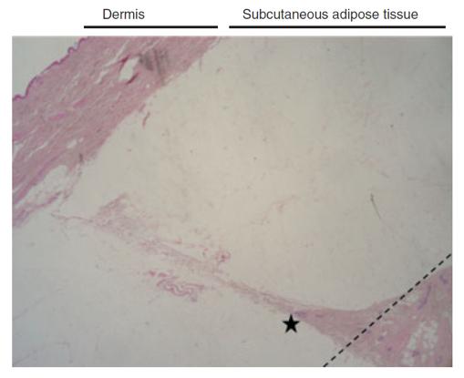 ONCOPLASTIC BREAST ANATOMY Dermis Subcutaneous adipose