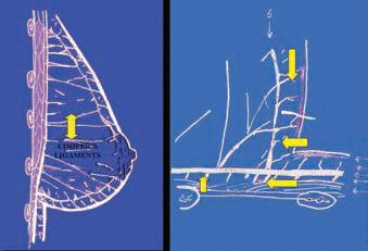The inframammary fold INFRAMAMMARY FOLD Fascia Mammae Cooper skin Deep fascia Scarpa Condensation of tissue