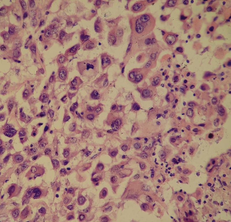 Undifferentiated carcinoma of the gall bladder: a rare entity Fig.
