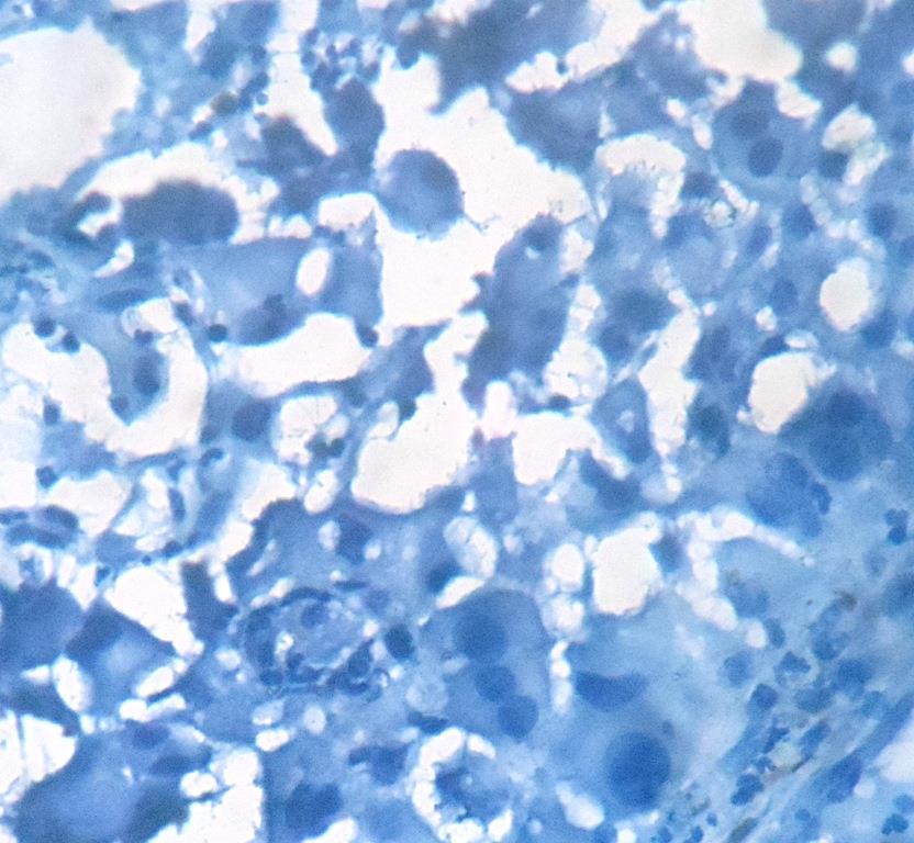 tumor cells (40X) Fig.