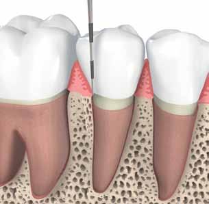 When plaque is not removed with regular brushing and flossing, gums can become reddened, swollen and may bleed.