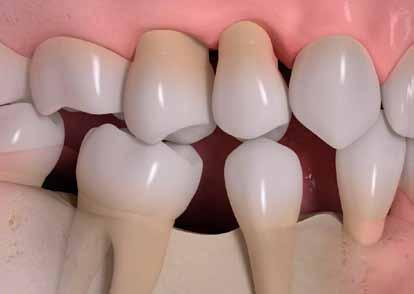 Why tooth loss matters Think of tooth loss and the first thing that comes to mind may be an unattractive appearance.