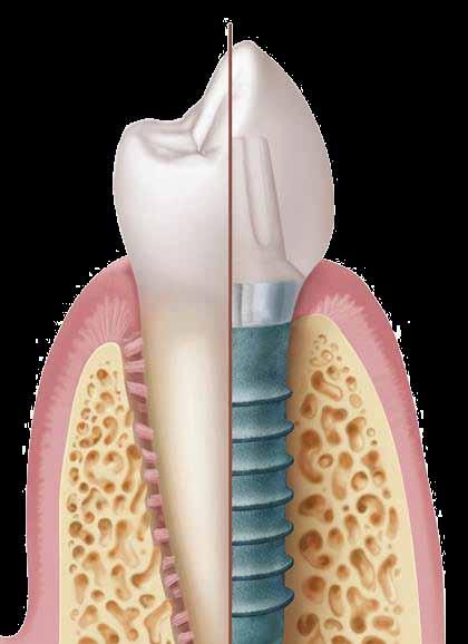 The beautiful nature of dental implants The best way to replace a tooth is to mimic it as closely as possible. Straumann dental implants do just that.