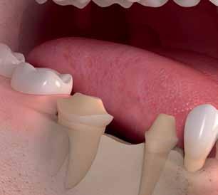 support a bridge. The bridge does not replace the tooth root.