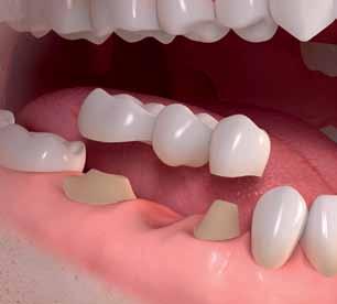 1 2 A tooth is missing 3 4 Neighboring teeth must be ground down to support a bridge