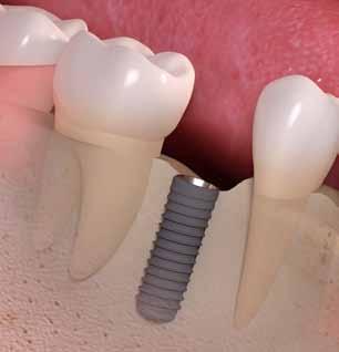 The dental implant advantage The implant solution: The dental implant replaces the root of the original