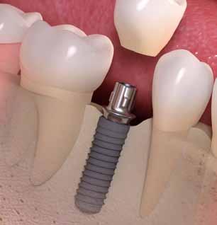 A dental implant also proves to be more cost-effective over time 1,2 and provides greater patient