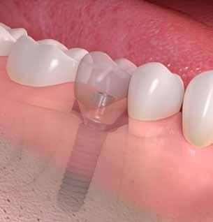 3 Tooth replacement with a dental implant and artificial crown 1 2 3 The implant replaces the tooth root