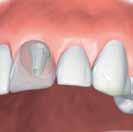 care as natural teeth Looks, feels and functions like natural teeth 1 2 Replacement of an individual tooth in the front region with an implant-supported crown 3 4 Replacement of an