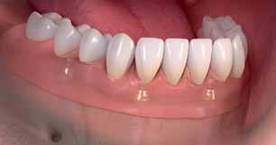 Eliminates pressure spots and sores caused by traditional dentures May