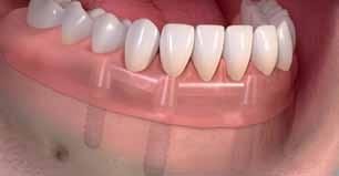 supported by 4 implants 4 Removable denture supported by 4 implants