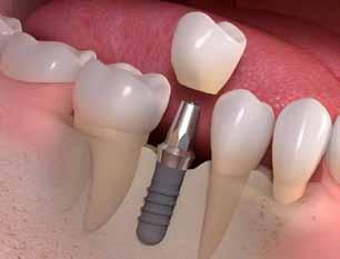 Temporary restoration: If the implant is in a visible area, a temporary restoration may be placed while the site heals.